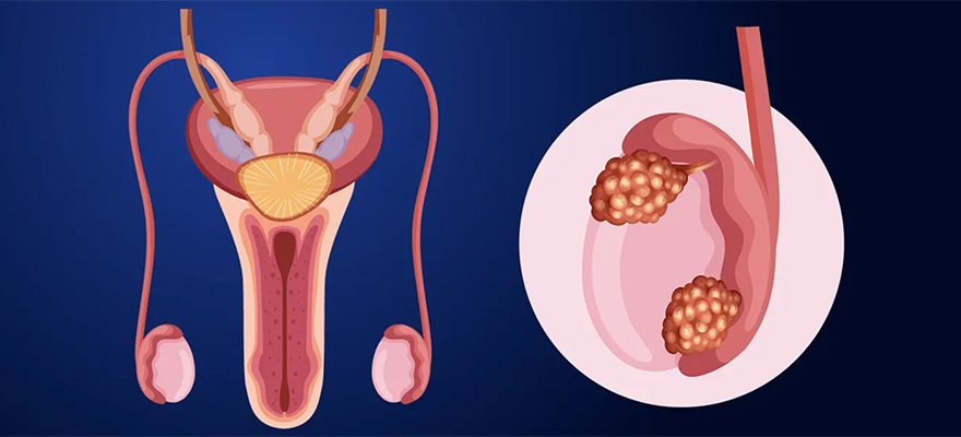 testicular-cancer